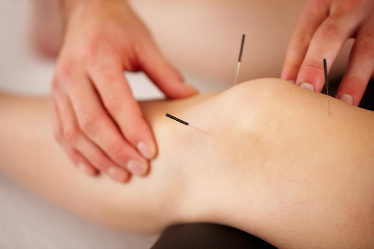 Acupuncture being performed in the knee